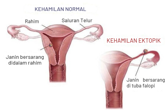 Bunda, si Kecil,3 Tanda, Hamil Ektopik, Tanda - Tanda, Bumil